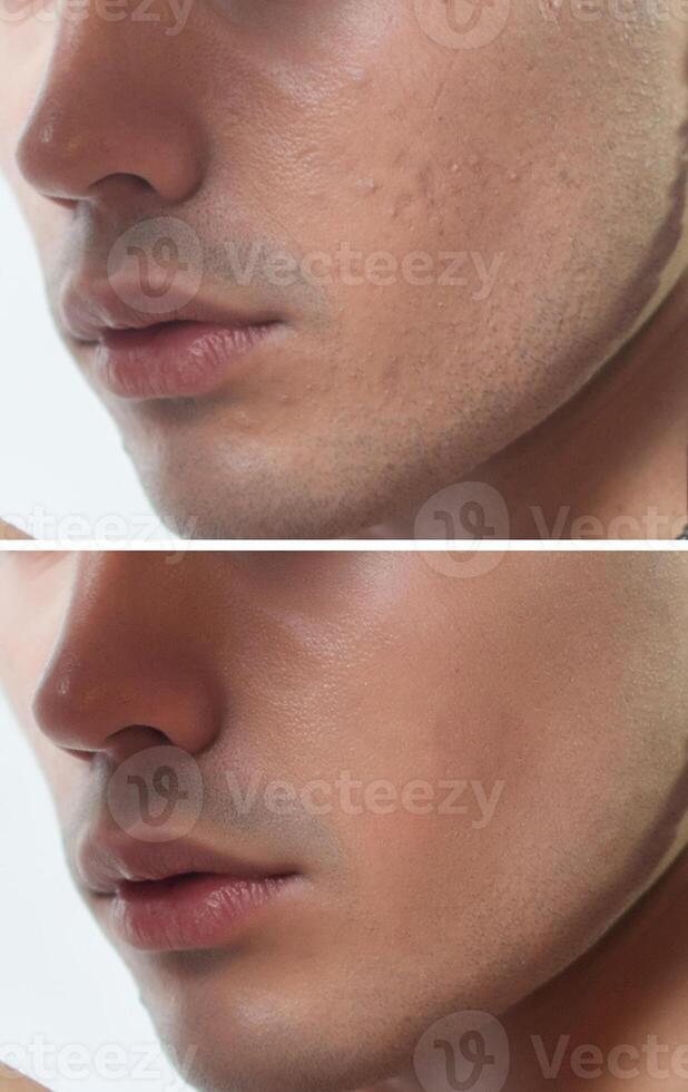 antes de y después cosmético operación. joven hombre retrato foto