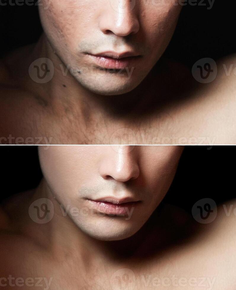 Before and after cosmetic operation. Young man portrait photo