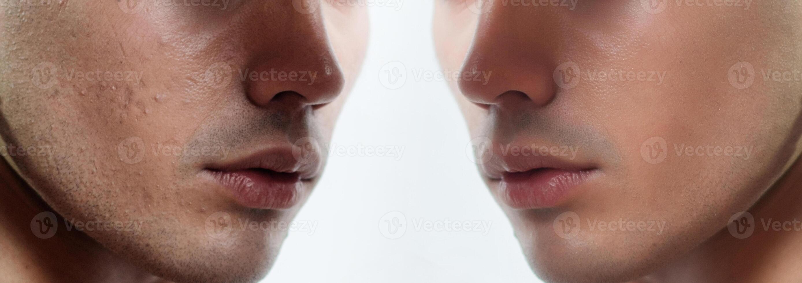 Before and after cosmetic operation. Young man portrait photo