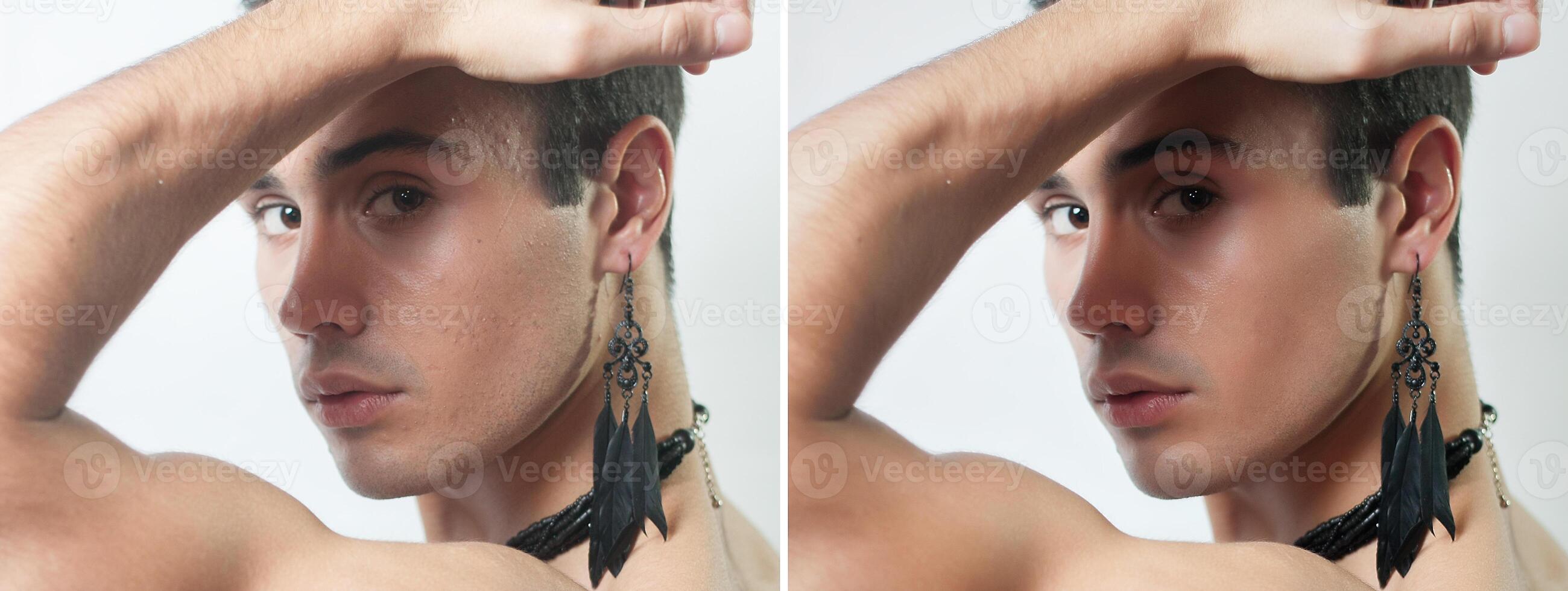 Before and after cosmetic operation. Young man portrait photo