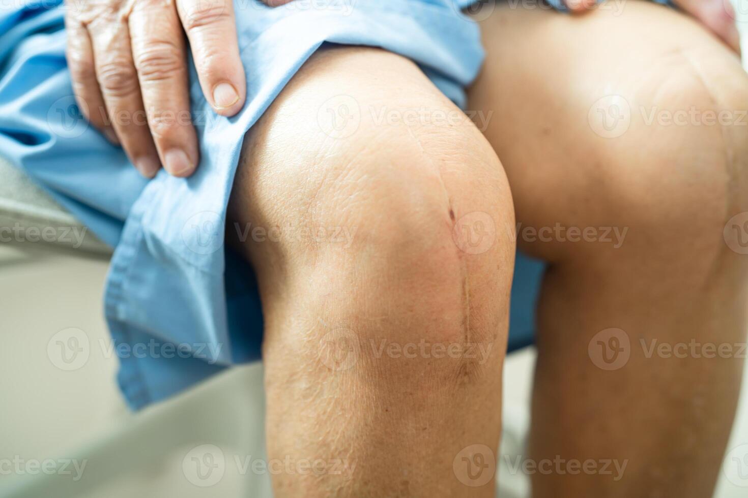 Asian elderly woman patient show her scars surgical total knee joint replacement Suture wound surgery arthroplasty on bed in hospital. photo