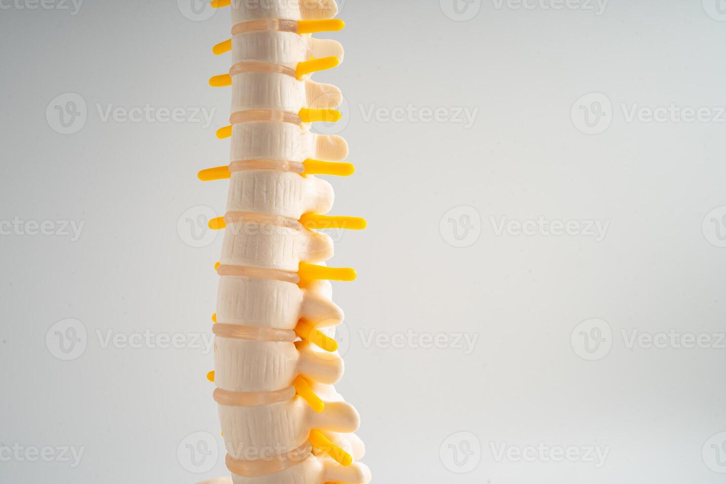 Lumbar spine displaced herniated disc fragment, spinal nerve and bone. Model for treatment medical in the orthopedic department. photo