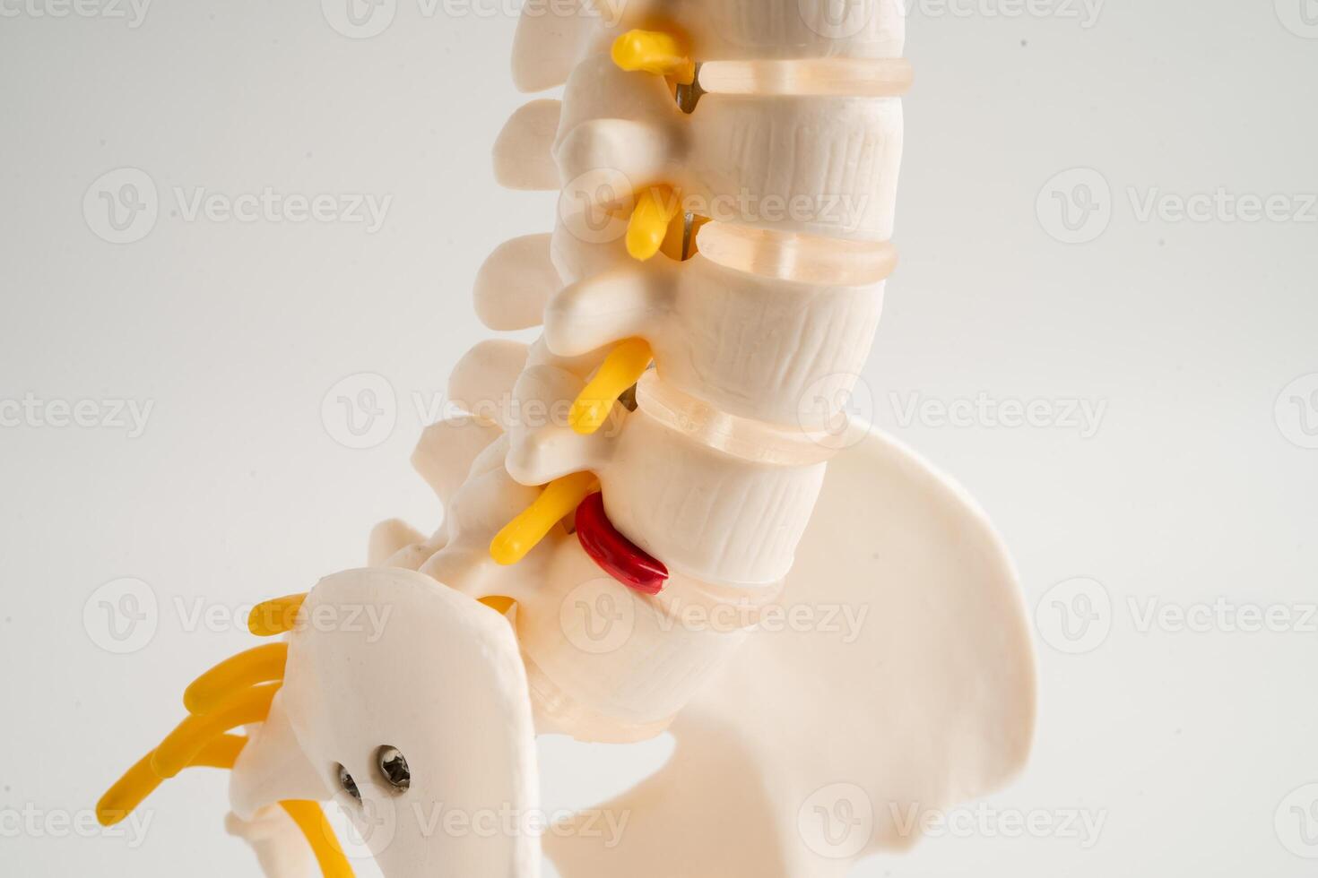 Lumbar spine displaced herniated disc fragment, spinal nerve and bone. Model for treatment medical in the orthopedic department. photo