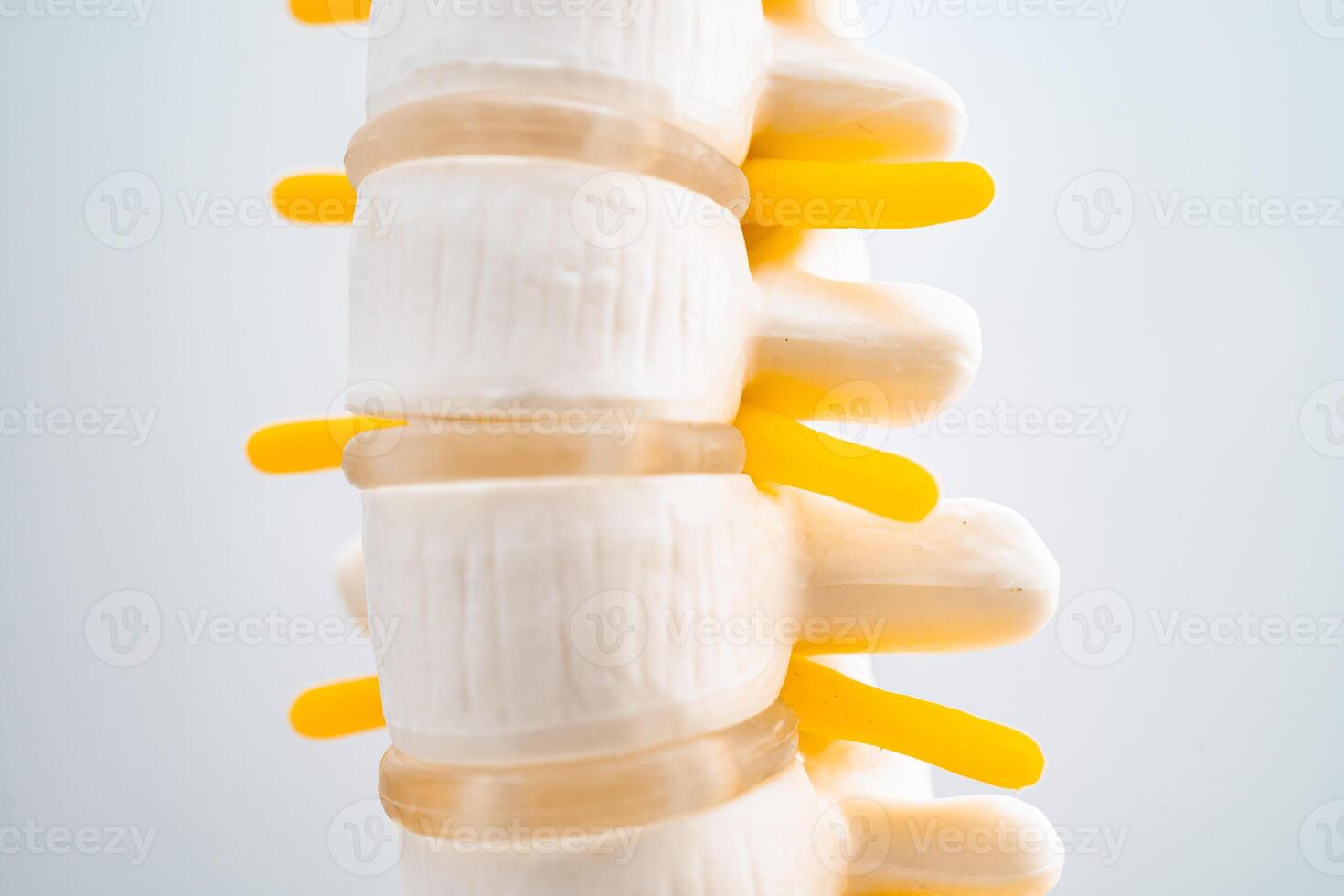 Lumbar spine displaced herniated disc fragment, spinal nerve and bone. Model for treatment medical in the orthopedic department. photo