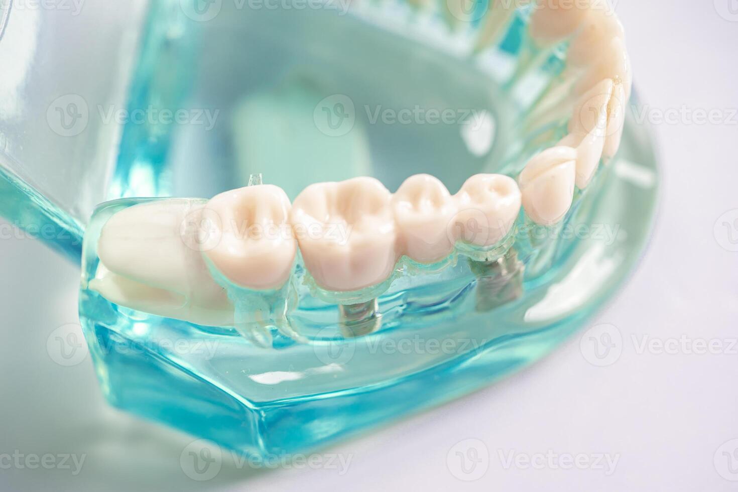 Dental implant, artificial tooth roots into jaw, root canal of dental treatment, gum disease, teeth model for dentist studying about dentistry. photo