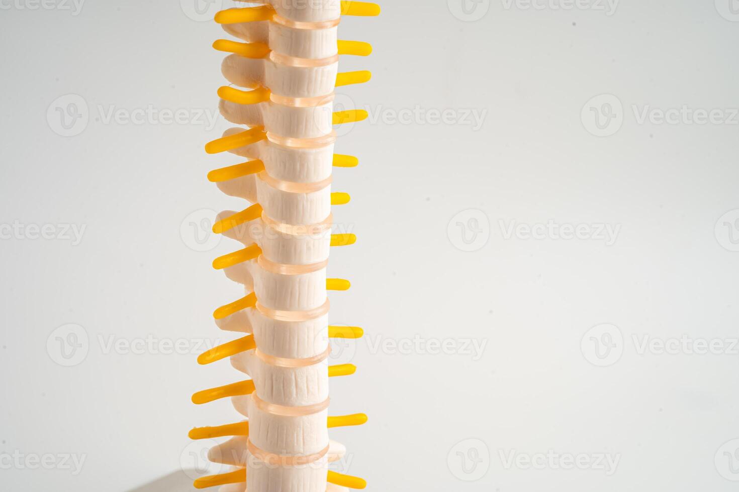 Lumbar spine displaced herniated disc fragment, spinal nerve and bone. Model for treatment medical in the orthopedic department. photo