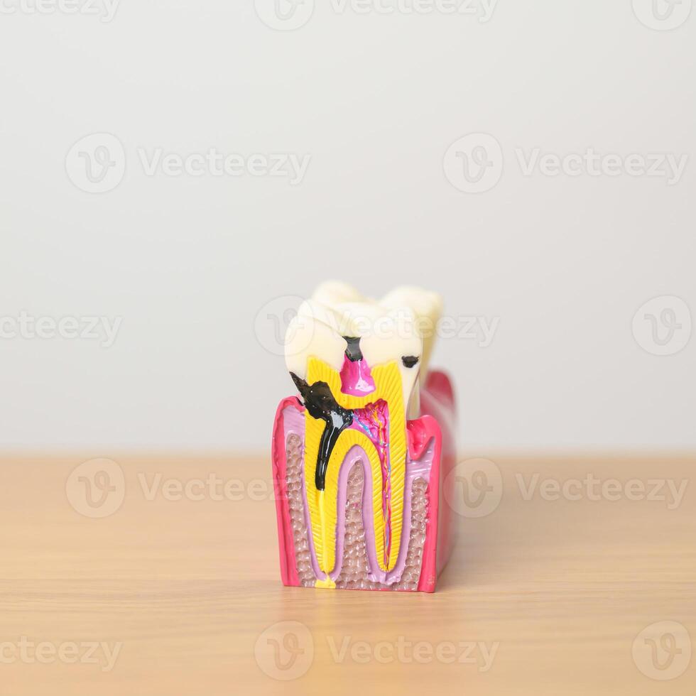 diente anatomía modelo. oral dientes decaer y enfermedad, raspar apagado sarro. marzo oral salud, dentista día, falso dientes. dolor de muelas y niños dental salud mes y ortodoncia salud día foto