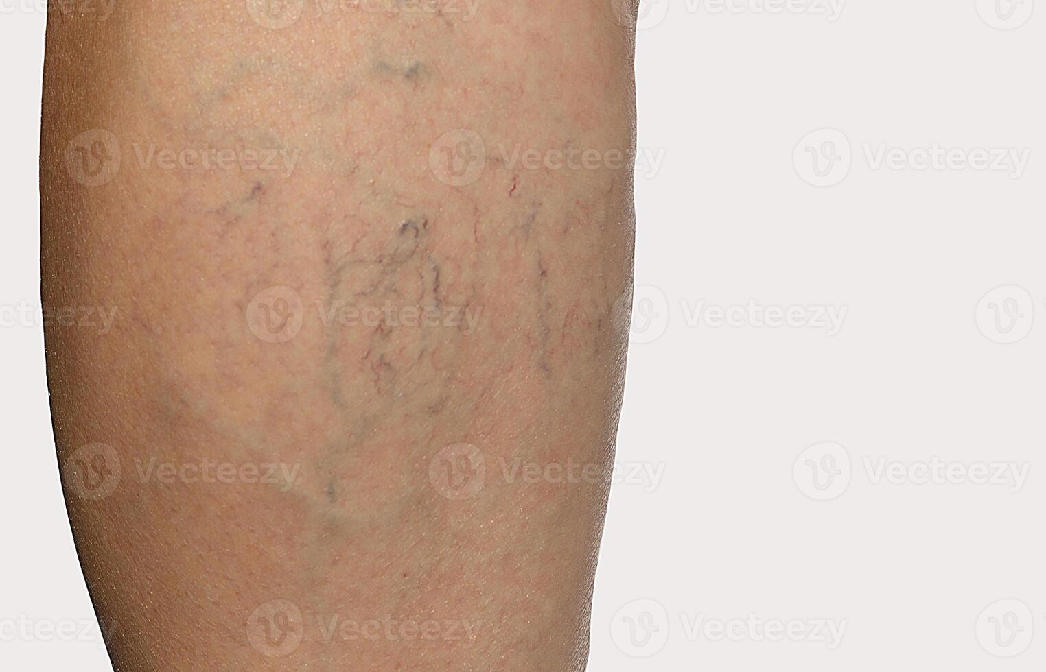 telangiectasia and spider veins on the leg. isolated on white background. free space for your text photo