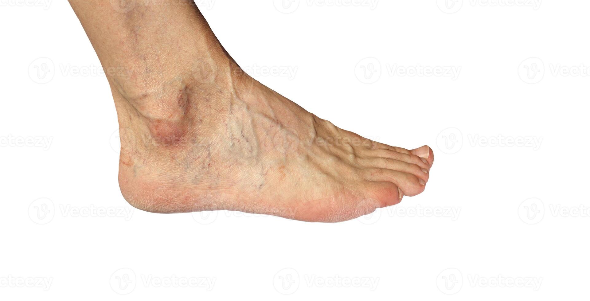 Varicose veins and vascular network on the legs. on a white background. Space for text.horizontal. photo