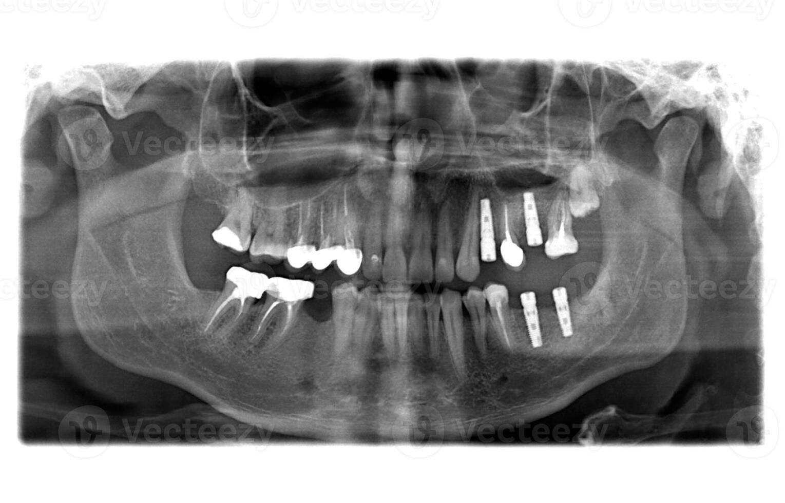 X ray of teeth photo