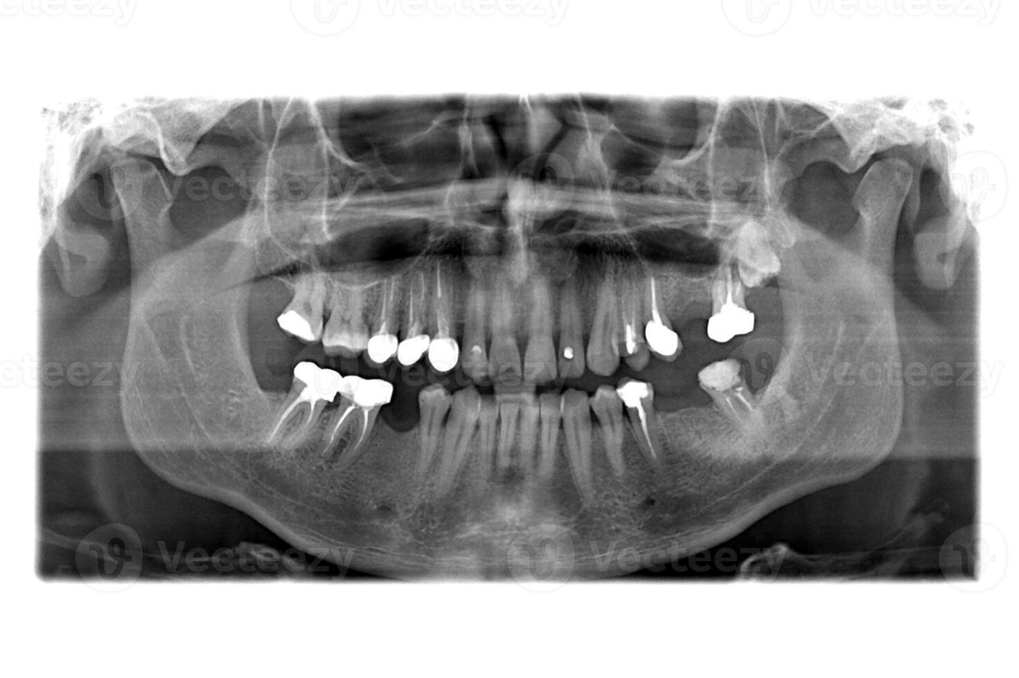 X rayo de dientes foto