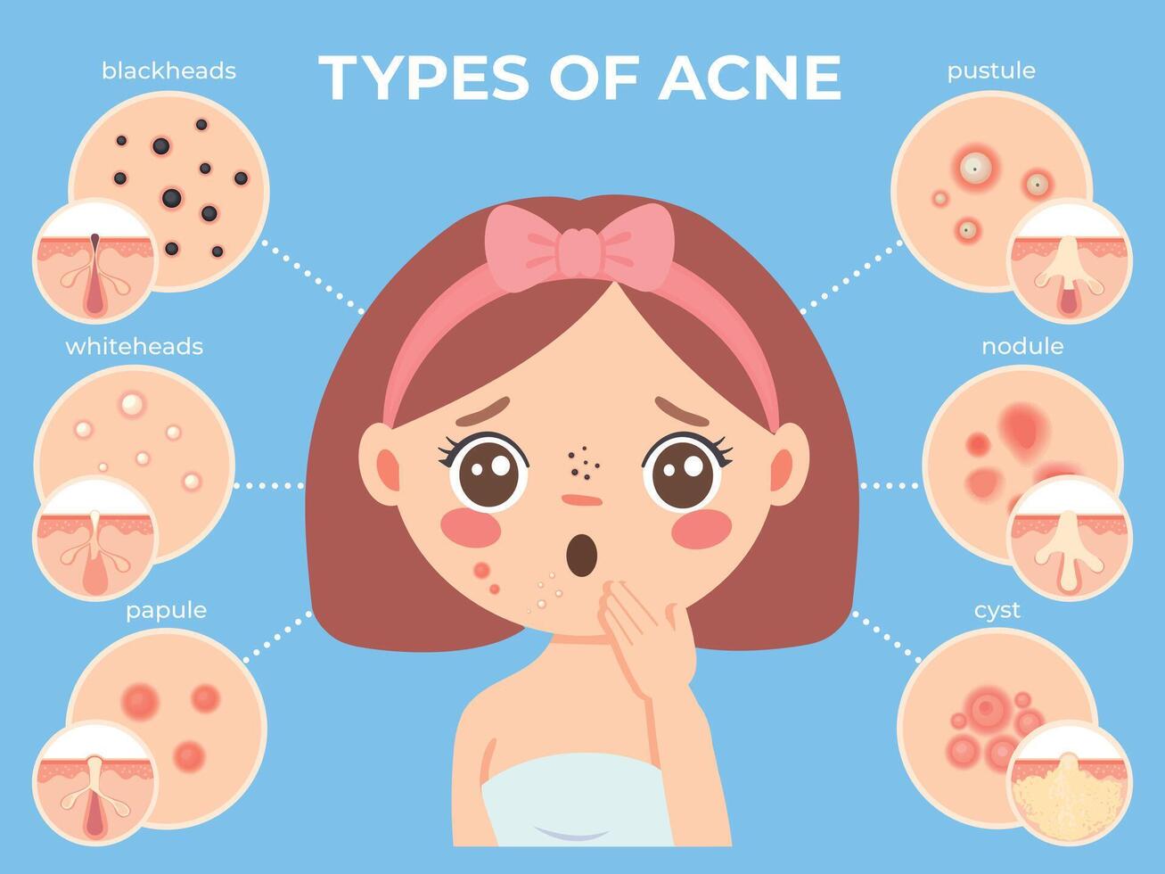 Girl with acne. Young unhappy female face with skin problems and pimple types icons. Dermatology and cosmetic skin care vector infographic