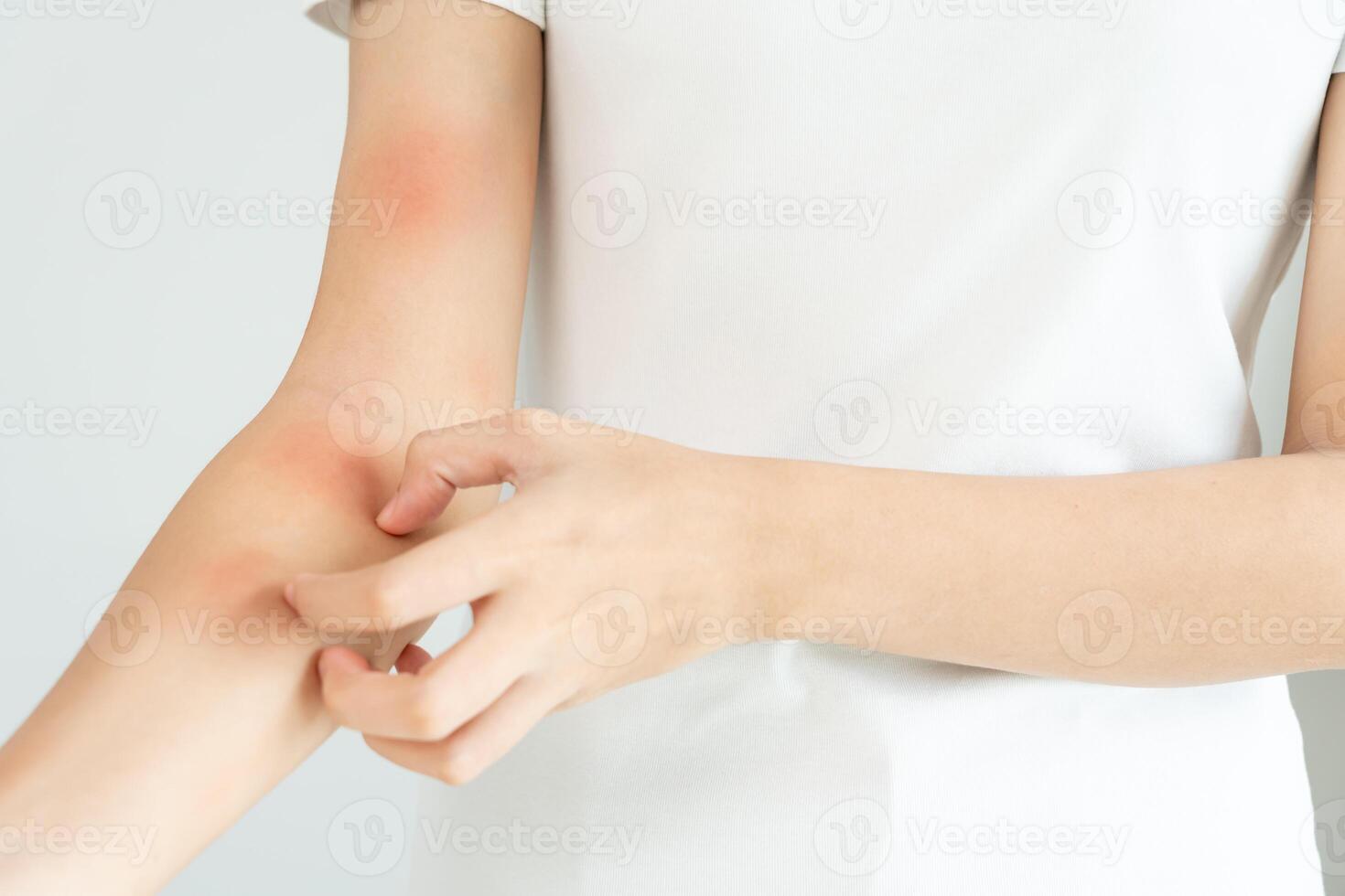 skin problem and beauty. Young woman scratch body has itchy skin from skin allergic, steroid allergy, sensitive skin, red from sunburn, chemical allergy, rash, insect bites, Seborrheic Dermatitis. photo