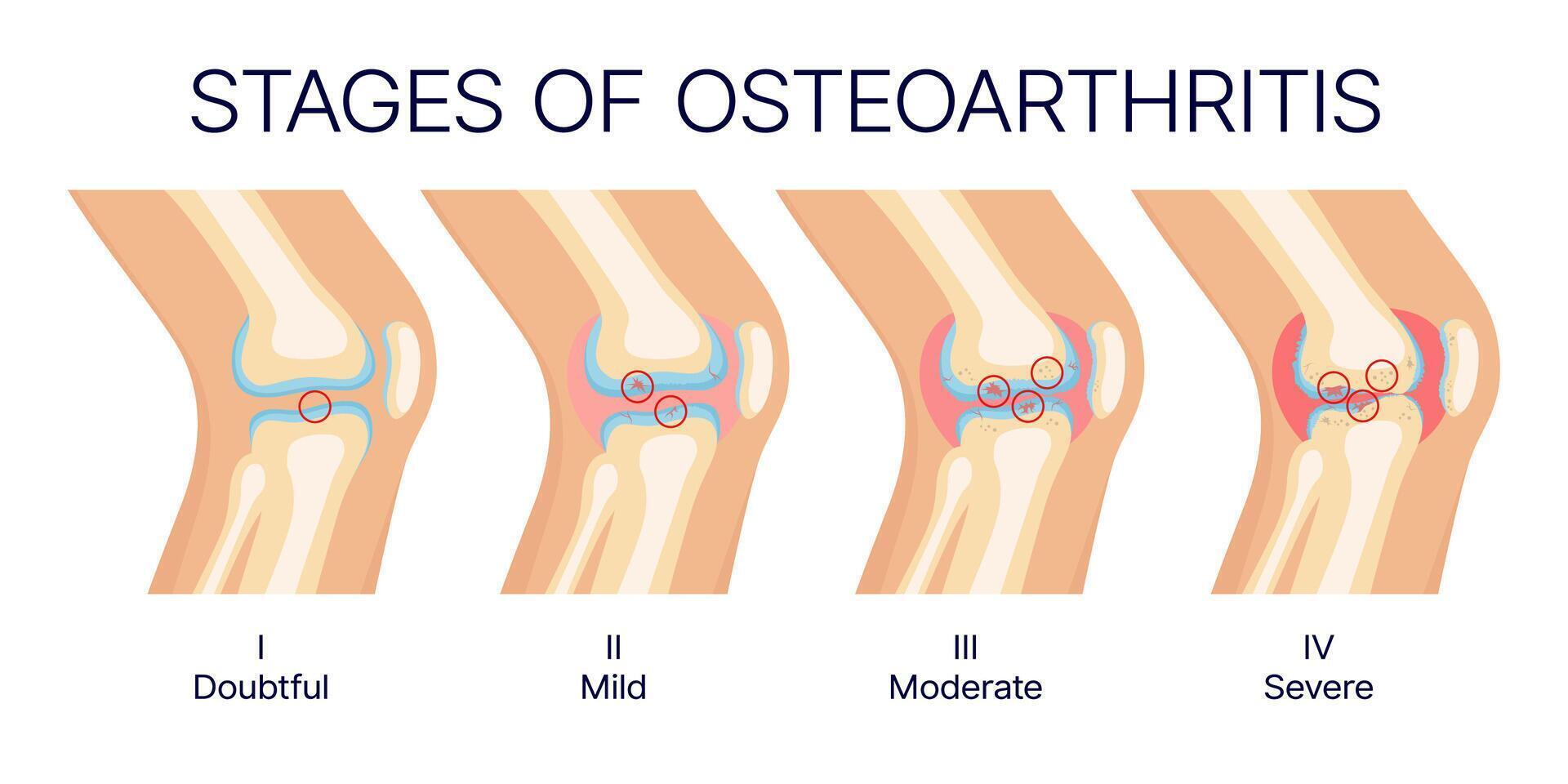 Knee osteoarthritis stages, joint and bone anatomy vector