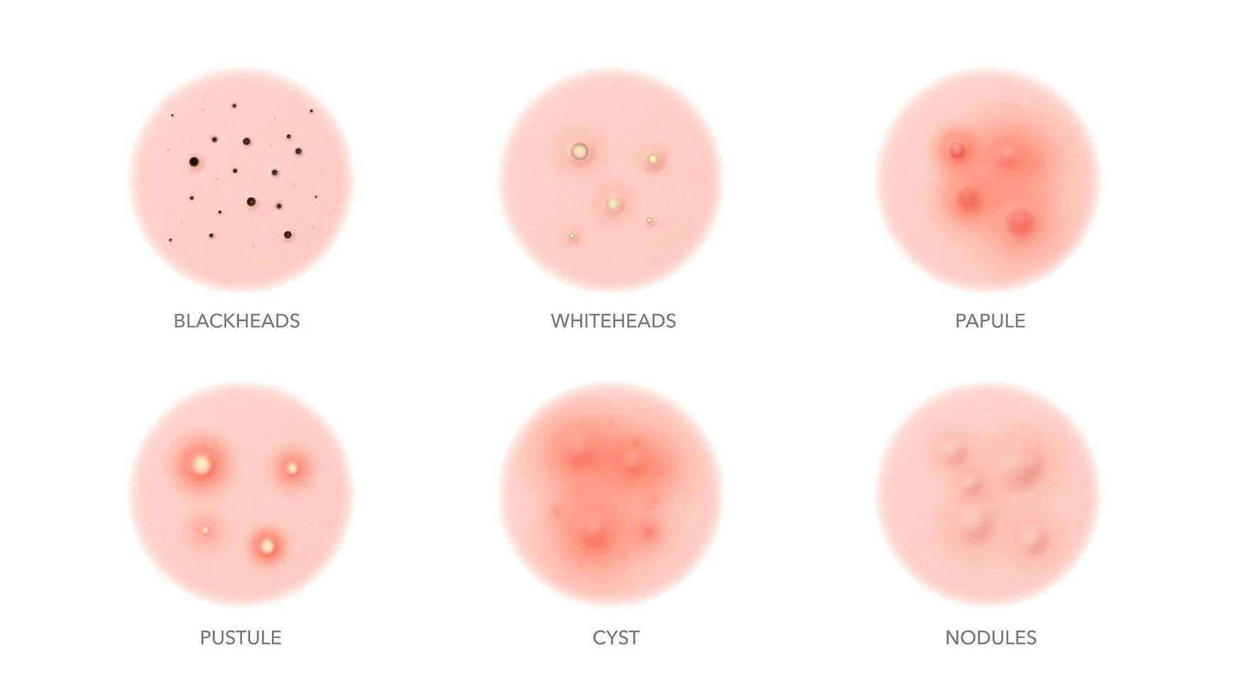 Acne types, body or face skin pimples inflammation vector