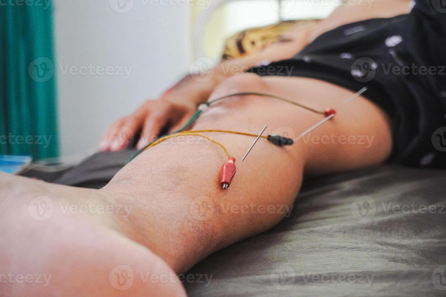 de cerca agujas en paciente cuerpo estimulado por eléctrico. acupuntura, chino alternativa medicamento. foto