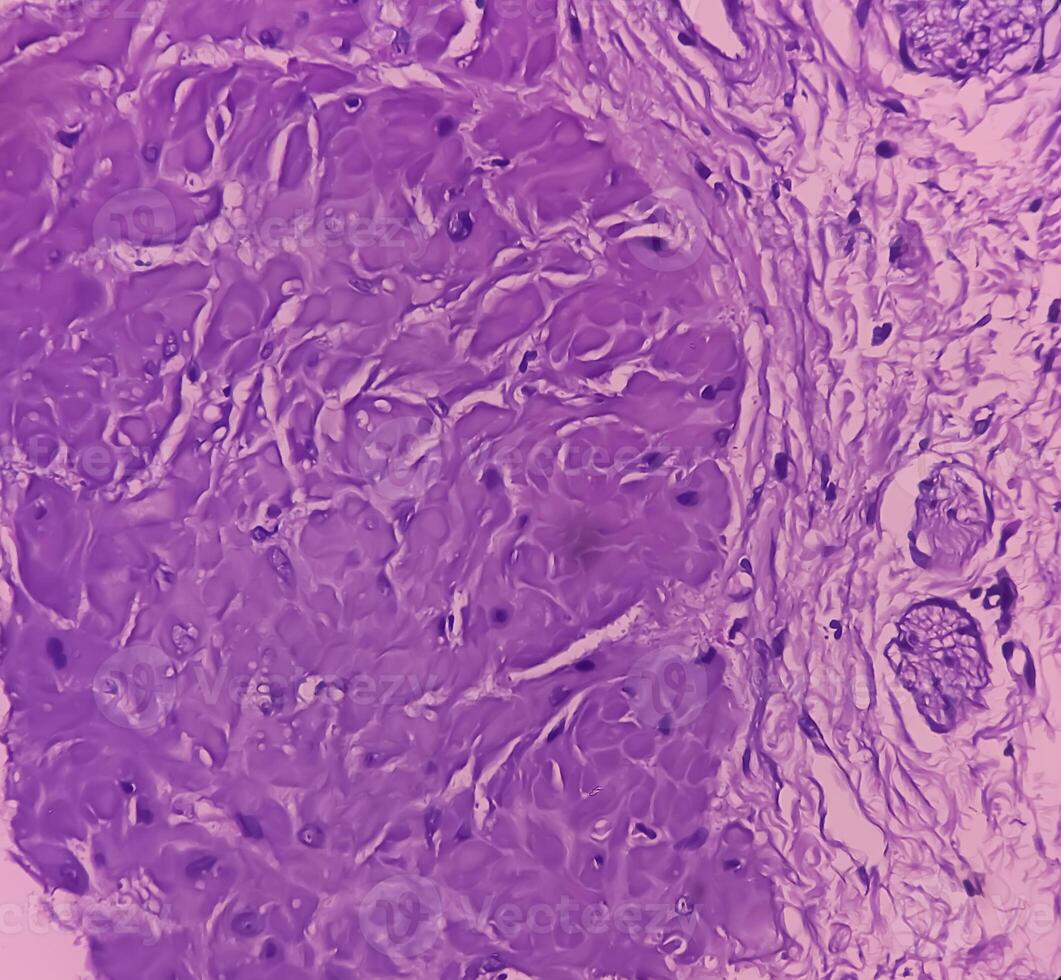 Prostatic Tissue biopsy. Sections show show fatty tissue, neural tissue and muscle tissue. Prostate cancer diagnosis. photo