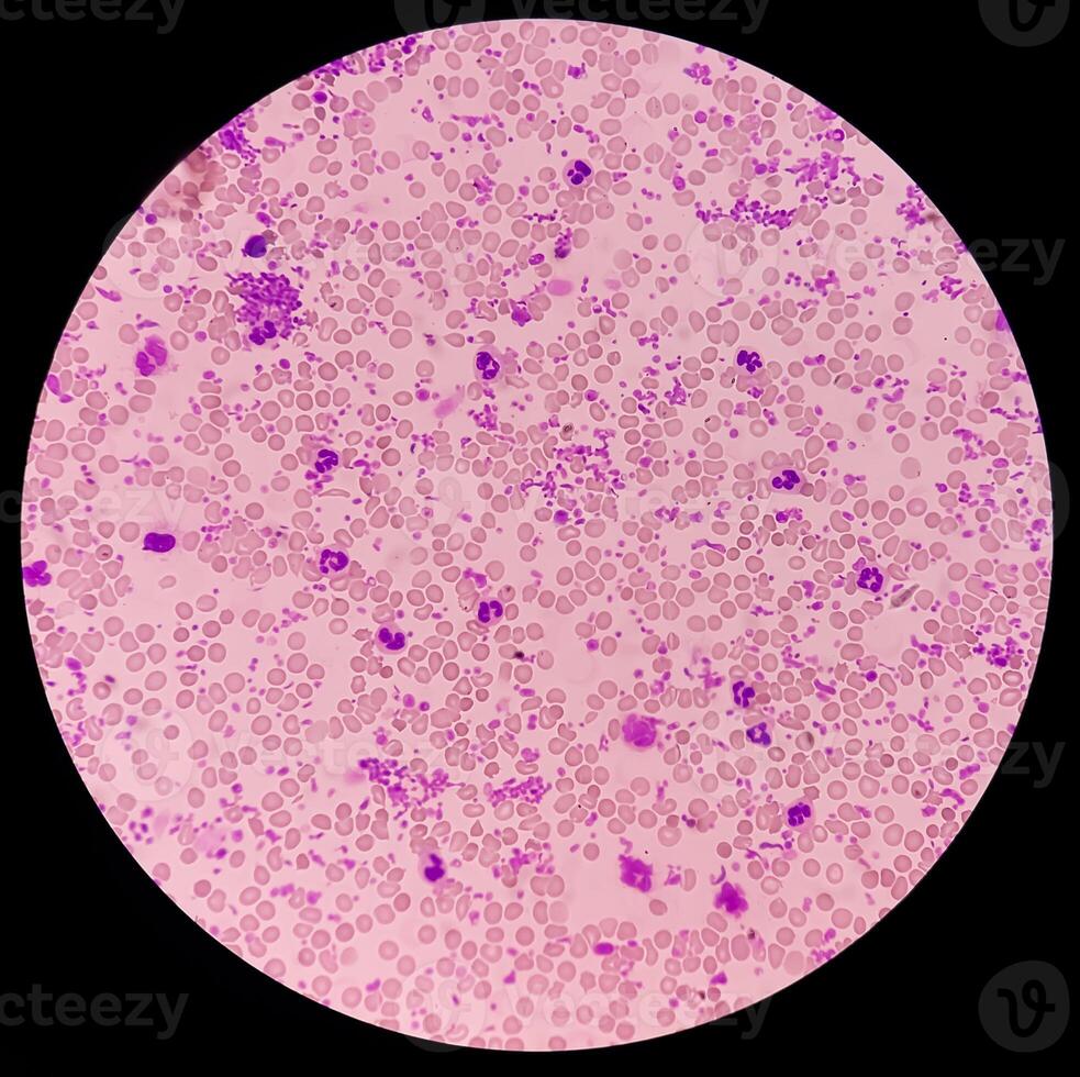 Essential thrombocytosis blood smear showing abnormal high volume of platelet and White Blood Cells. Panmyelosis. Myeloprokiferative disorder. photo