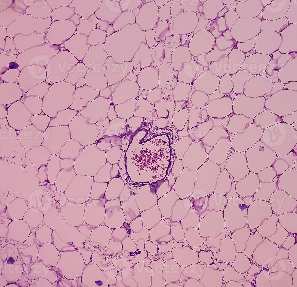 lipoma en lomo, benigno crecimiento de graso tejido, benigno neoplasma, adipocitos, parcialmente capsulado tumor, 40x microscópico vista. foto