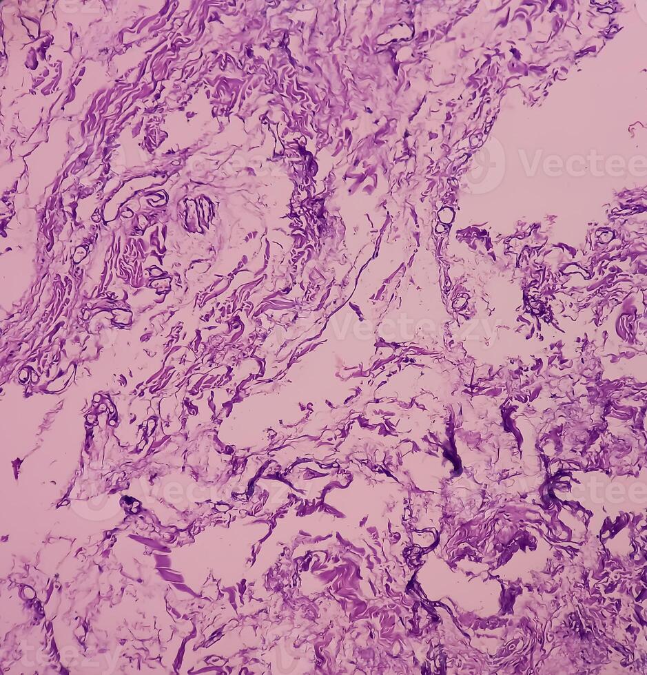 Lipoma on loin, benign growth of fatty tissue, benign neoplasm, adipocytes, partially capsulated tumor, 40x microscopic view. photo