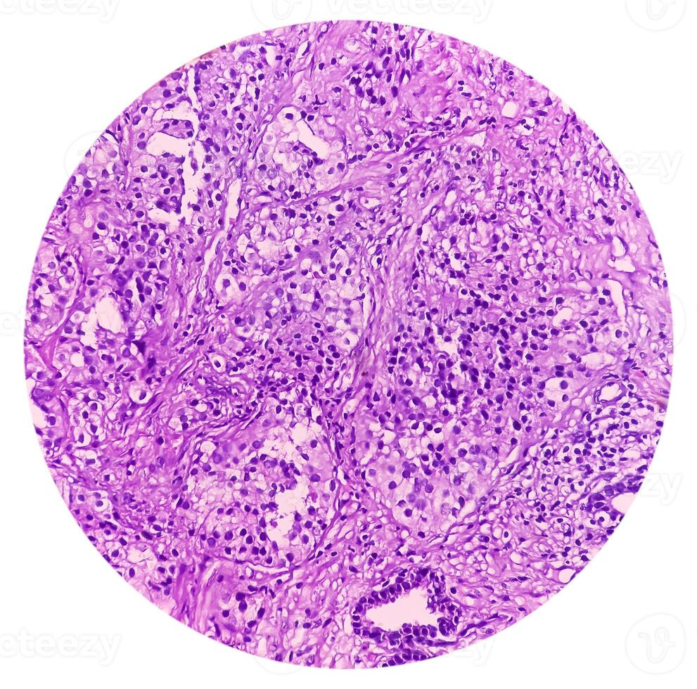 Prostatic Tissue biopsy. Sections show show fatty tissue, neural tissue and muscle tissue. Prostate cancer diagnosis. photo