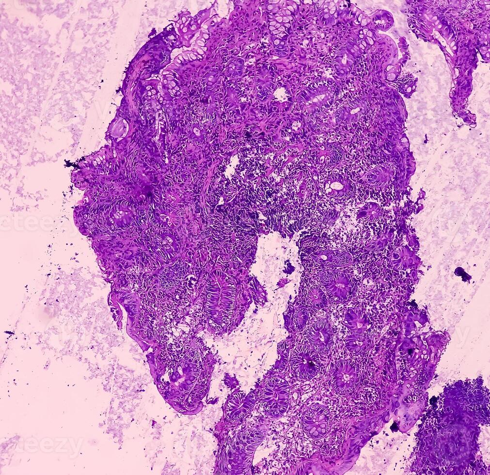 Ileo-cecal ulcer. Chronic nonspecific ileitis with ulcer. Section show ileal mucosa, dense infiltration of lymphocytes, histiocytes, plasma cell in lamina propria. IBD. photo