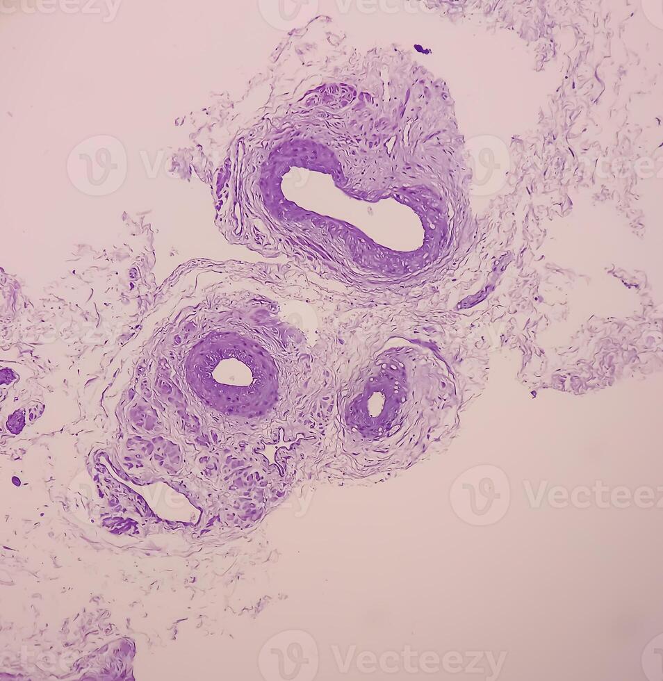 Prostatic Tissue biopsy. Sections show show fatty tissue, neural tissue and muscle tissue. Prostate cancer diagnosis. photo