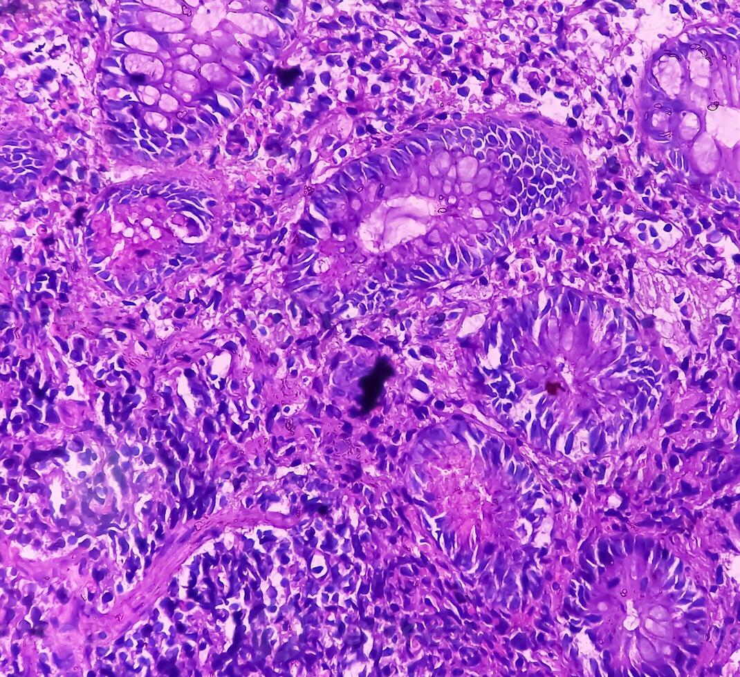 Ileo-cecal ulcer. Chronic nonspecific ileitis with ulcer. Section show ileal mucosa, dense infiltration of lymphocytes, histiocytes, plasma cell in lamina propria. IBD. photo