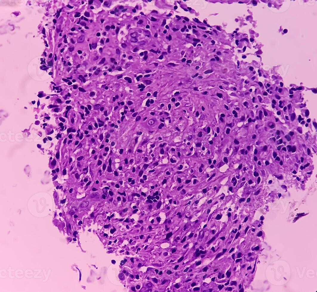 Thyroid cancer. Microscopic image of Follicular neoplasm. Malignant neoplasm of atypical thyroid follicular epithelial cells. Some of cells show pleomorphism with nuclear grooving. Nodular goiter. photo