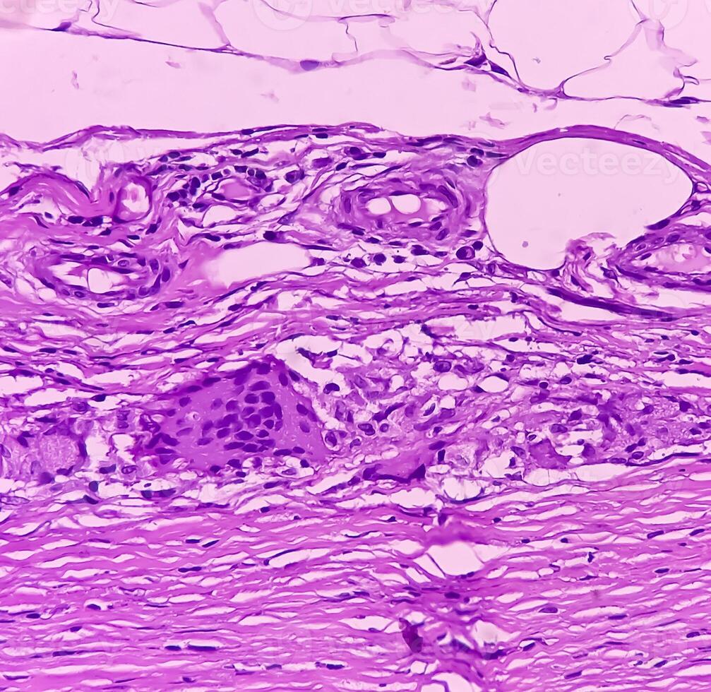 Thyroid cancer. Microscopic image of Follicular neoplasm. Malignant neoplasm of atypical thyroid follicular epithelial cells. Some of cells show pleomorphism with nuclear grooving. Nodular goiter. photo