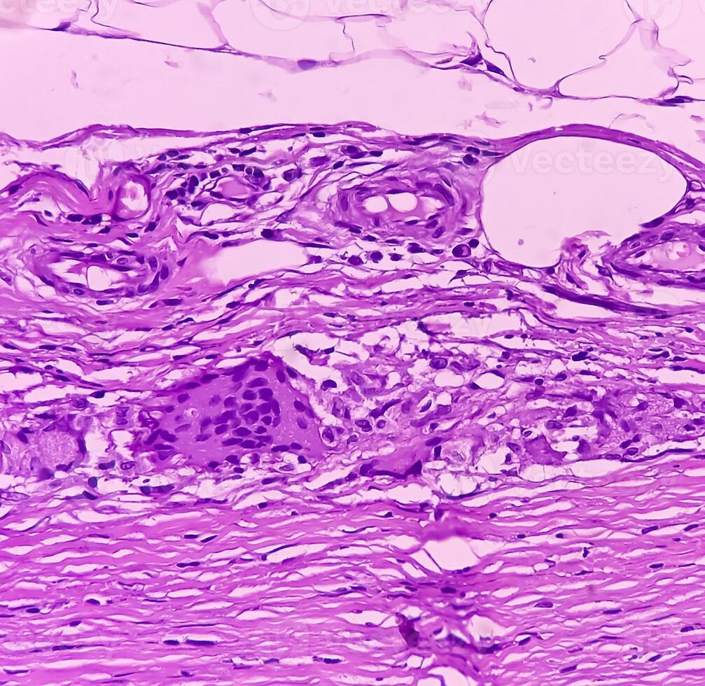 tiroides cáncer. microscópico imagen de folicular neoplasma. maligno neoplasma de atípico tiroides folicular epitelial células. algunos de células espectáculo pleomorfismo con nuclear ranurado. nodular coto. foto