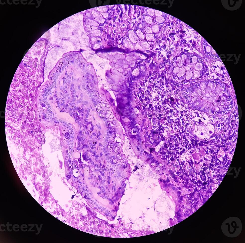 Ileo-cecal ulcer. Chronic nonspecific ileitis with ulcer. Section show ileal mucosa, dense infiltration of lymphocytes, histiocytes, plasma cell in lamina propria. IBD. photo