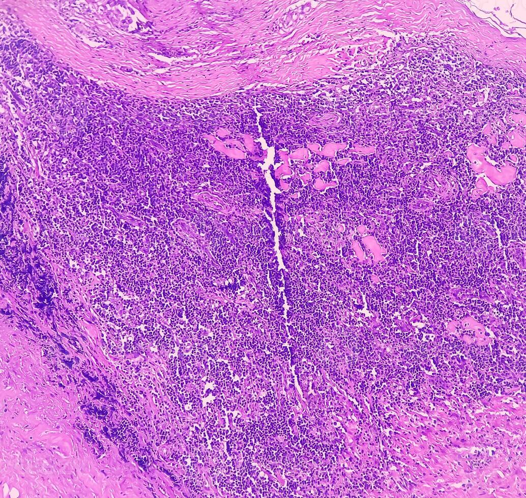 tiroides cáncer. microscópico imagen de folicular neoplasma. maligno neoplasma de atípico tiroides folicular epitelial células. algunos de células espectáculo pleomorfismo con nuclear ranurado. nodular coto. foto