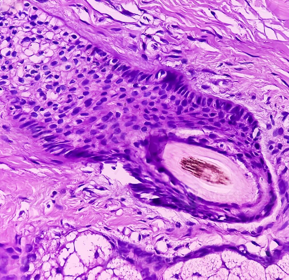 Lipoma on loin, benign growth of fatty tissue, benign neoplasm, adipocytes, partially capsulated tumor, 40x microscopic view. photo