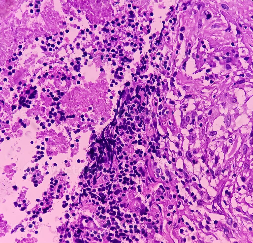 Thyroid cancer. Microscopic image of Follicular neoplasm. Malignant neoplasm of atypical thyroid follicular epithelial cells. Some of cells show pleomorphism with nuclear grooving. Nodular goiter. photo