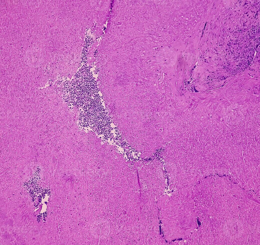 Thyroid cancer. Microscopic image of Follicular neoplasm. Malignant neoplasm of atypical thyroid follicular epithelial cells. Some of cells show pleomorphism with nuclear grooving. Nodular goiter. photo