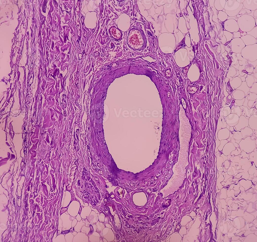 Lipoma on loin, benign growth of fatty tissue, benign neoplasm, adipocytes, partially capsulated tumor, 40x microscopic view. photo