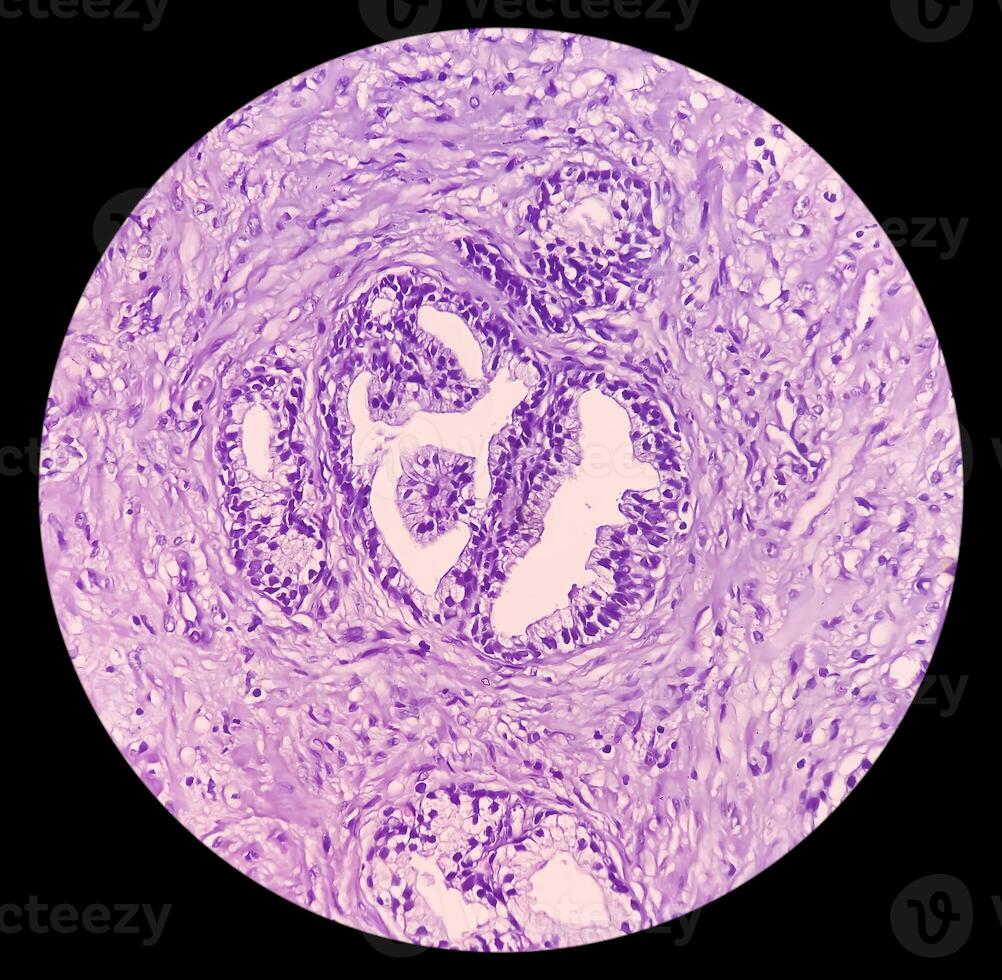 Prostatic Tissue biopsy. Sections show show fatty tissue, neural tissue and muscle tissue. Prostate cancer diagnosis. photo