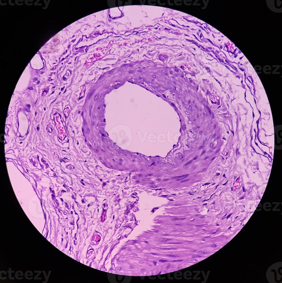 Lipoma on loin, benign growth of fatty tissue, benign neoplasm, adipocytes, partially capsulated tumor, 40x microscopic view. photo