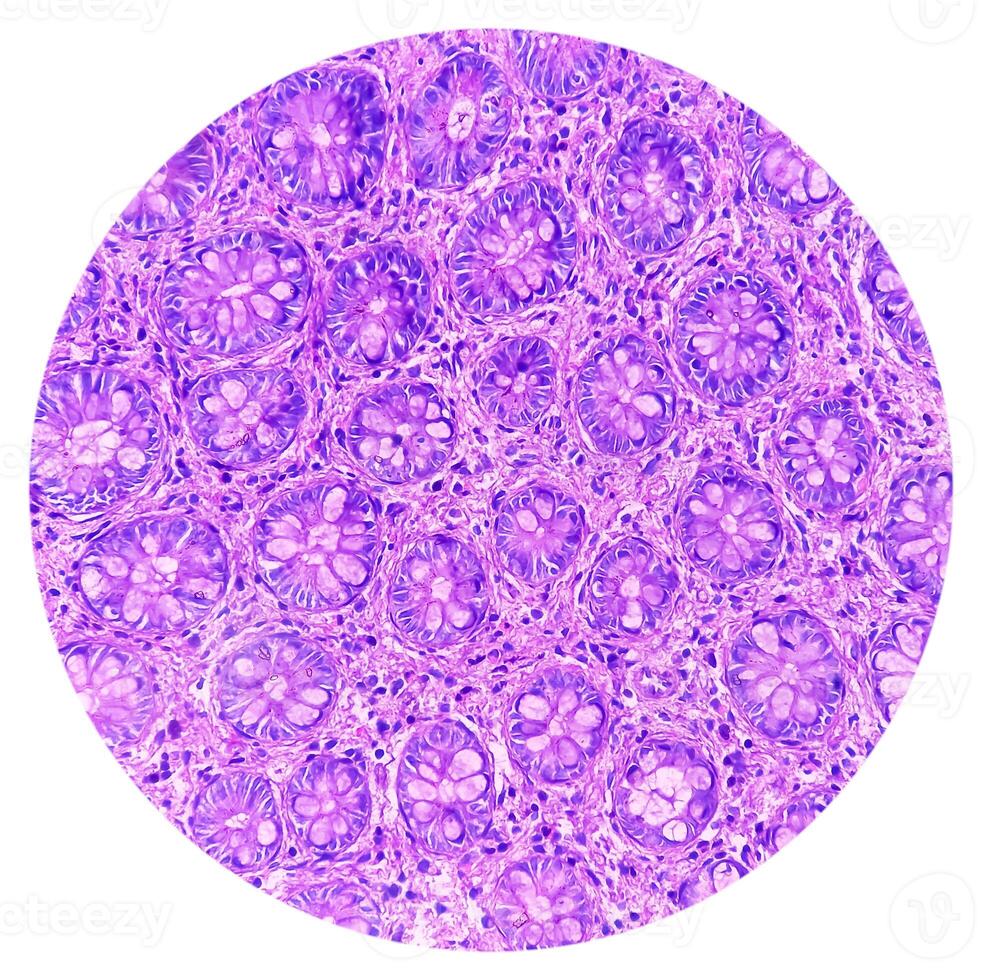 Ileo-cecal ulcer. Chronic nonspecific ileitis with ulcer. Section show ileal mucosa, dense infiltration of lymphocytes, histiocytes, plasma cell in lamina propria. IBD. photo