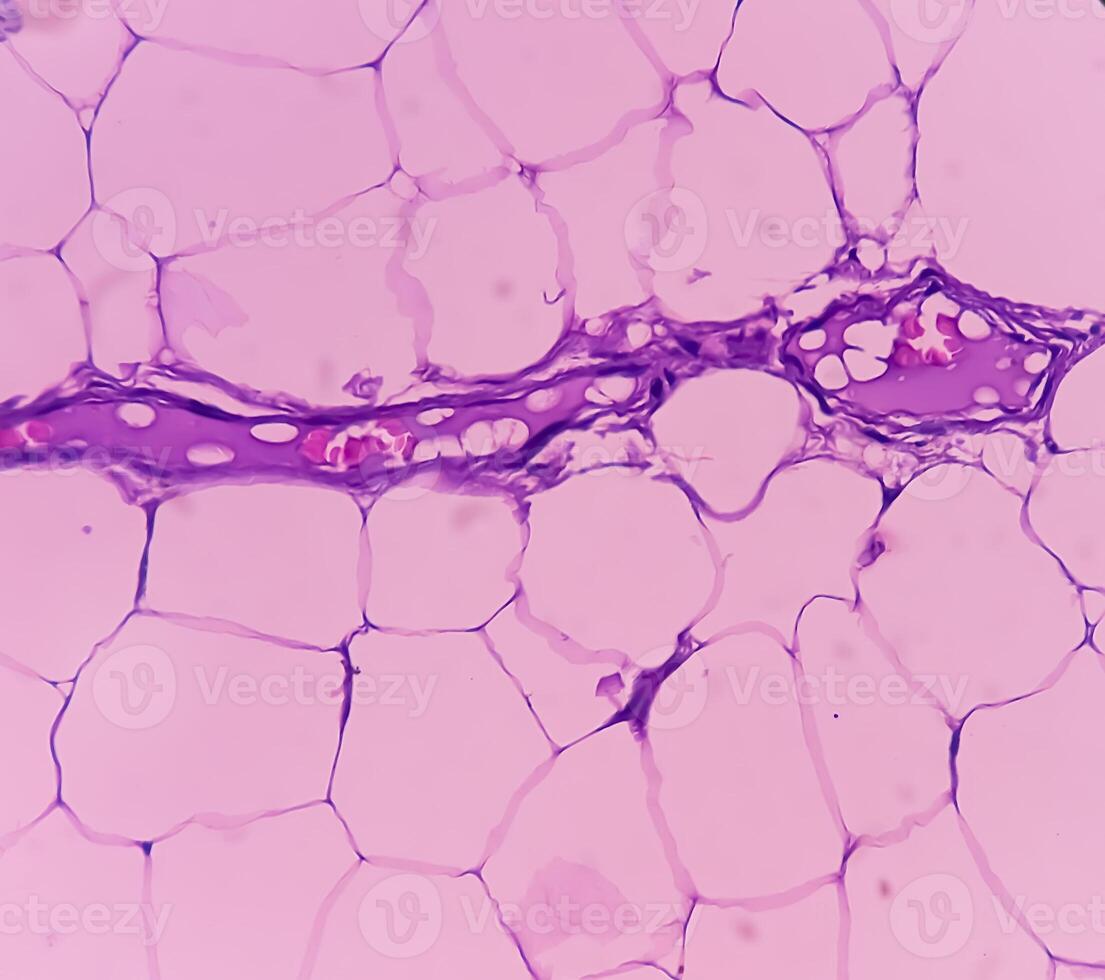 Lipoma on cubital fossa, benign growth of fatty tissue, benign neoplasm, adipocytes, partially capsulated tumor, 40x microscopic view. photo