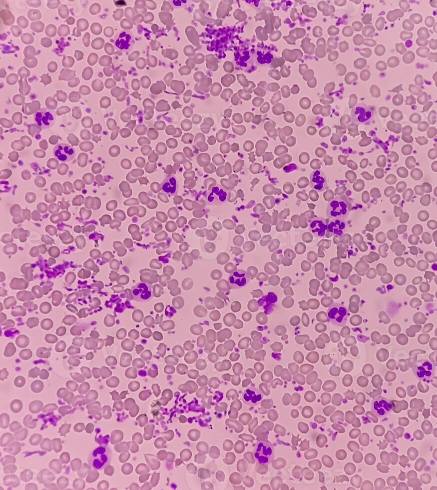 Essential thrombocytosis blood smear showing abnormal high volume of platelet and White Blood Cells. Panmyelosis. Myeloprokiferative disorder. photo