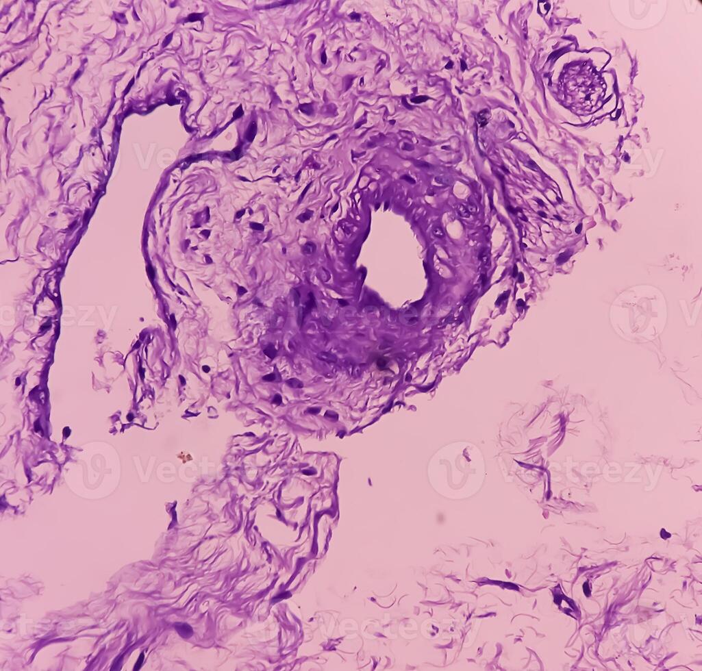 Prostatic Tissue biopsy. Sections show show fatty tissue, neural tissue and muscle tissue. Prostate cancer diagnosis. photo
