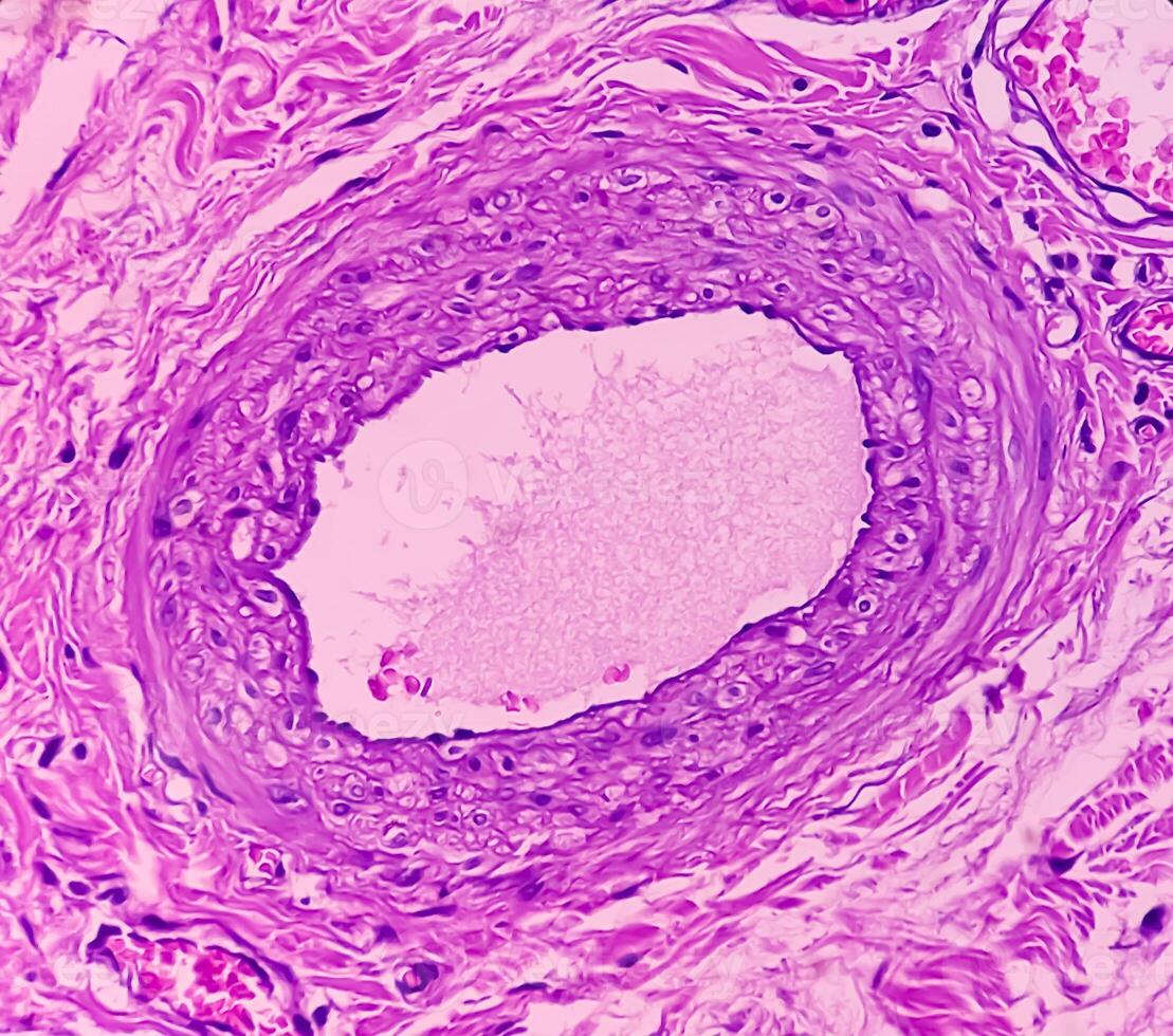 Lipoma on loin, benign growth of fatty tissue, benign neoplasm, adipocytes, partially capsulated tumor, 40x microscopic view. photo