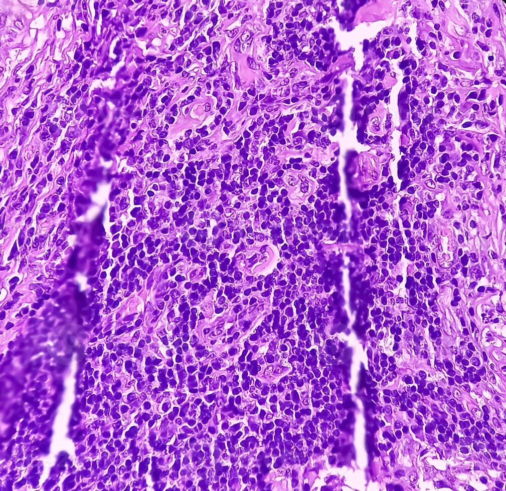 Thyroid cancer. Microscopic image of Follicular neoplasm. Malignant neoplasm of atypical thyroid follicular epithelial cells. Some of cells show pleomorphism with nuclear grooving. Nodular goiter. photo