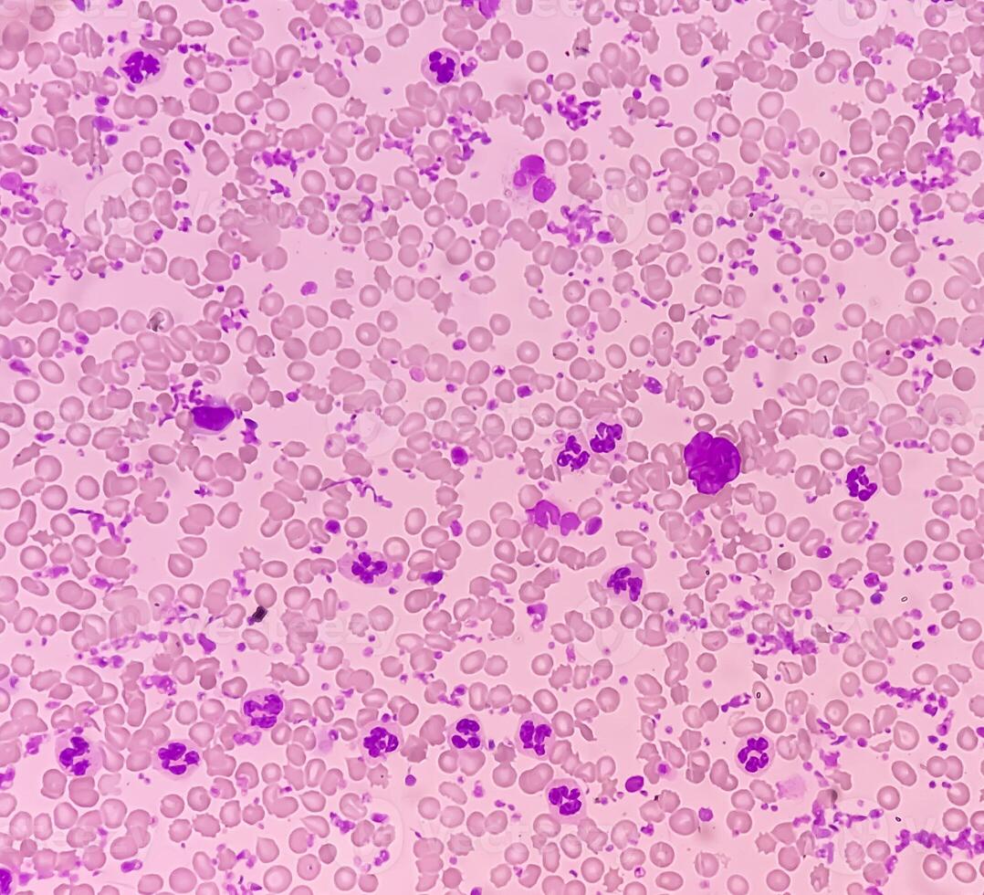 Essential thrombocytosis blood smear showing abnormal high volume of platelet and White Blood Cells. Panmyelosis. Myeloprokiferative disorder. photo