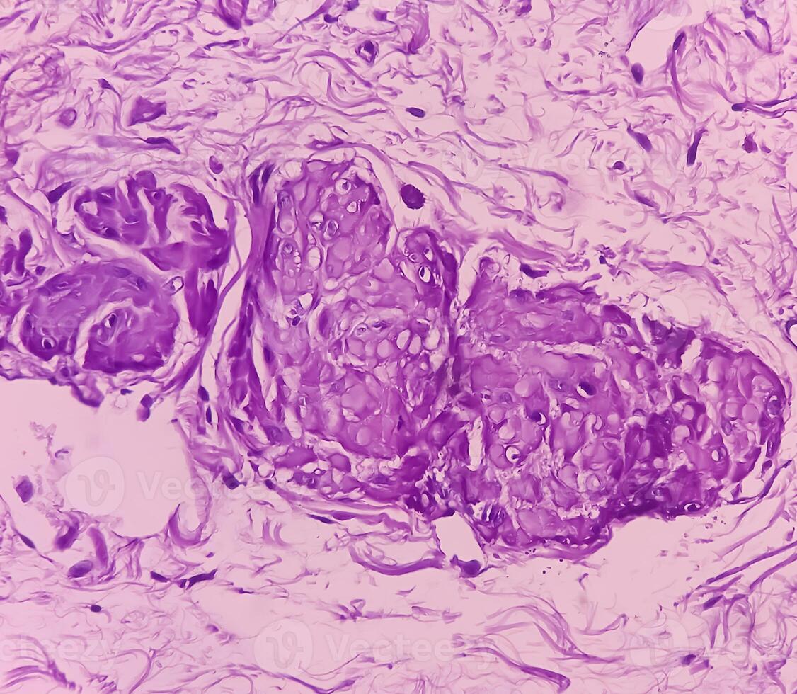 Prostatic Tissue biopsy. Sections show show fatty tissue, neural tissue and muscle tissue. Prostate cancer diagnosis. photo