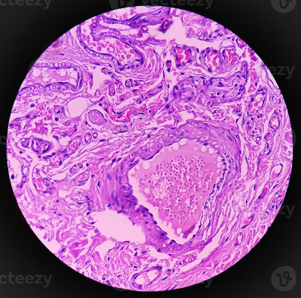 Lipoma on loin, benign growth of fatty tissue, benign neoplasm, adipocytes, partially capsulated tumor, 40x microscopic view. photo