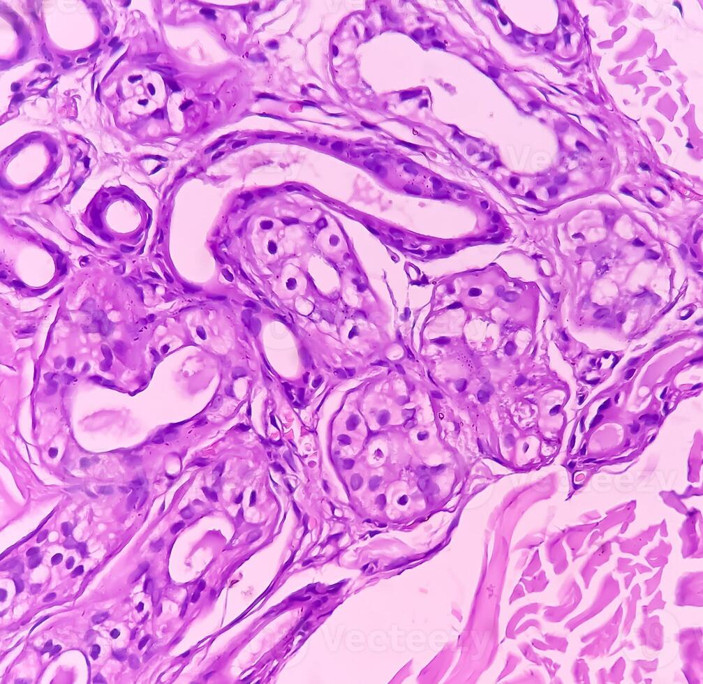 Lipoma on loin, benign growth of fatty tissue, benign neoplasm, adipocytes, partially capsulated tumor, 40x microscopic view. photo