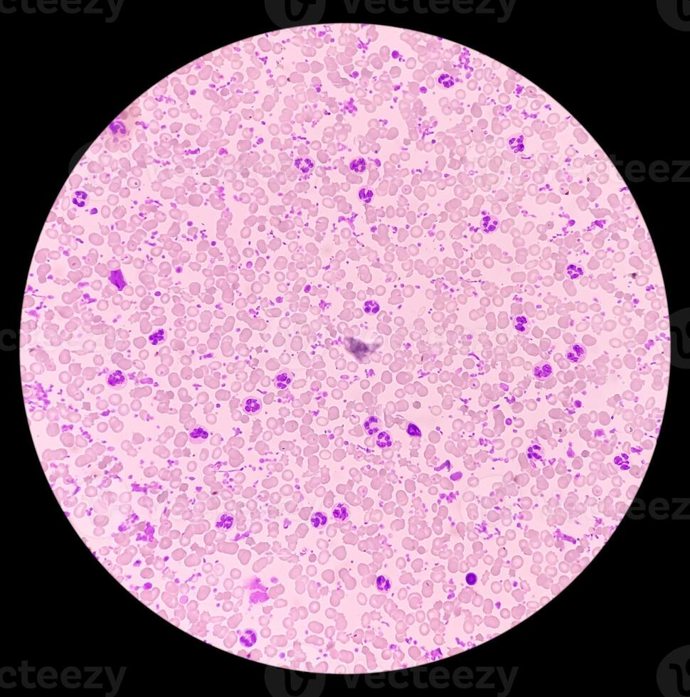 Essential thrombocytosis blood smear showing abnormal high volume of platelet and White Blood Cells. Panmyelosis. Myeloprokiferative disorder. photo